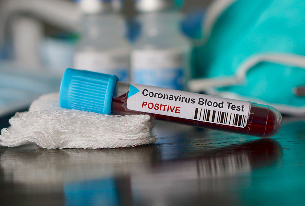 Test Tube With Blood Sample Positive In Coronavirus